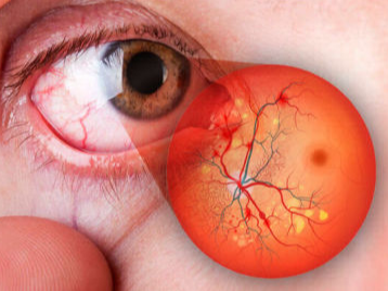Retinopatía Diabética
